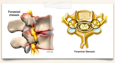 conditionsimg-foraminalstenosis