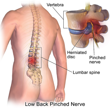 dureri de șold și hernie intervertebrală