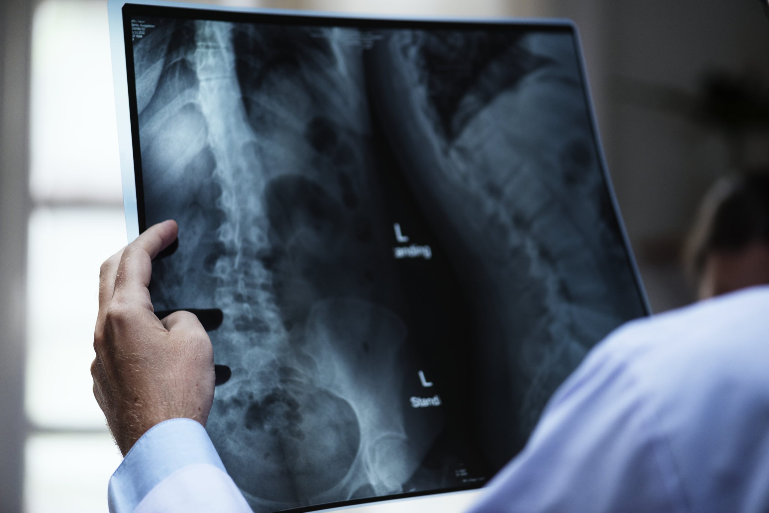 Medic neurochirurg analizează un RMN înainte de operația de hernie de disc