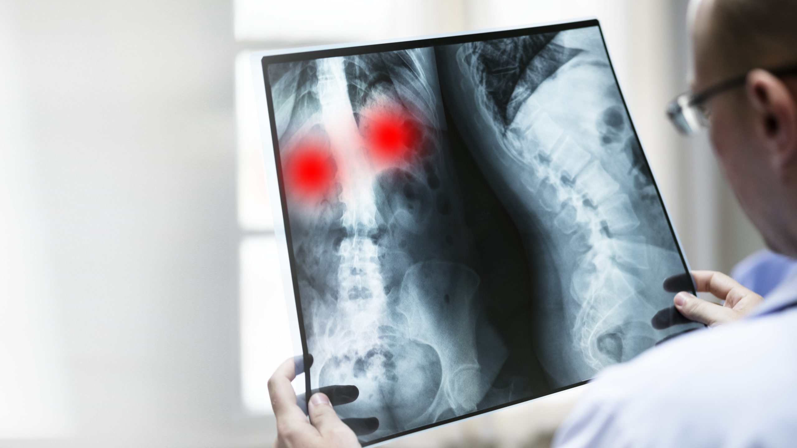 infiltratii hernie de disc ghidaj imagistic Bucuresti